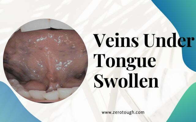 What Do Dark Veins Under Tongue Mean